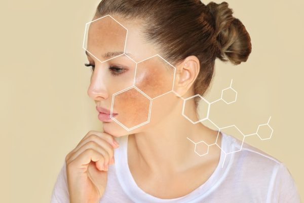 Trị nám da mặt